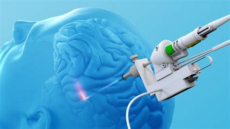 Hoy Digital   Nuevo método láser para tumores cerebrales y epilepsia ...