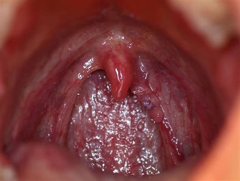 HPV e cancro orale: dati allarmanti tra gli uomini in USA