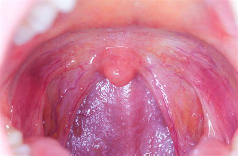 Hpv squamous cell carcinoma throat, Romjoh 8  1  by ...