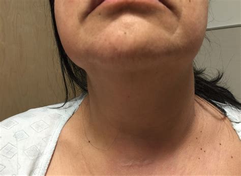 Huge save in a patient with neck swelling : POCUS Blog