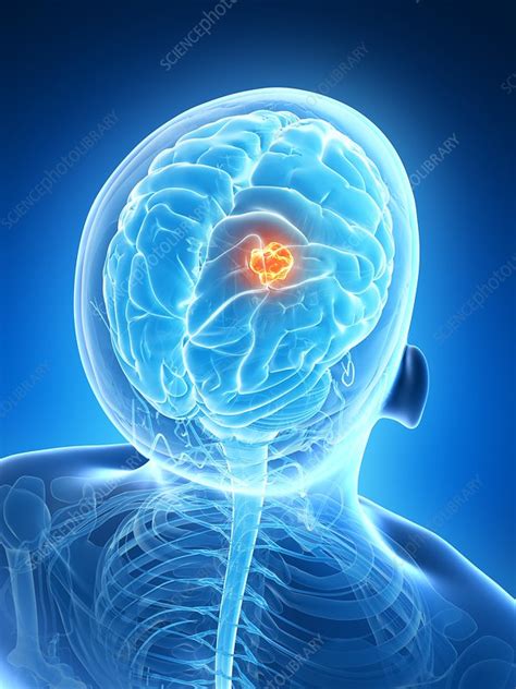 Human brain tumor, illustration   Stock Image   F010/8825 ...