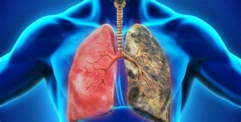 Humo de tabaco, principal causa de enfermedad pulmonar ...