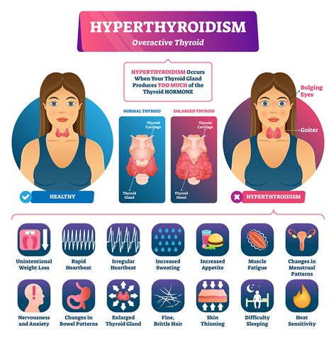 Hyperthyroidism Heal & Specialists | Next Advanced Medicine