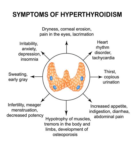 Hyperthyroidism Heal & Specialists | Next Advanced Medicine