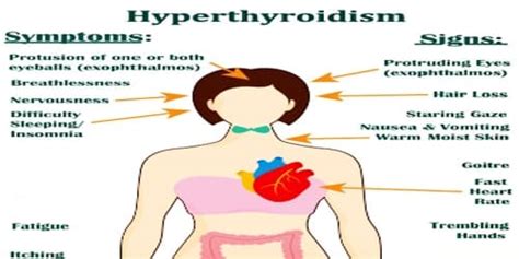 Hyperthyroidism  Symptoms, Diagnosis, and treatment ...