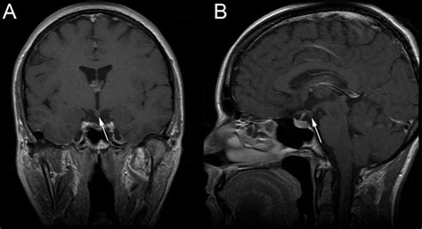 Hypothalamic hamartoma | BMJ Case Reports