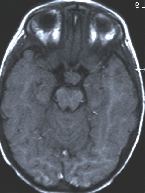 Hypothalamic hamartoma | Eurorad