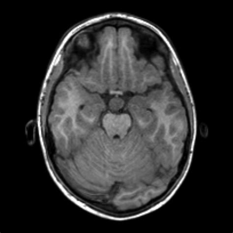 Hypothalamic hamartoma | Image | Radiopaedia.org