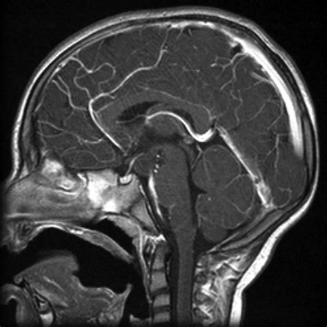 Hypothalamic hamartoma | Image | Radiopaedia.org