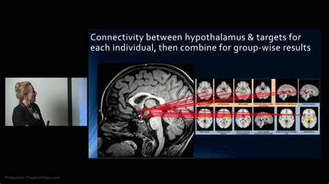 Hypothalamic Hamartoma: Imaging Use in Diagnosis & Management by Varina ...