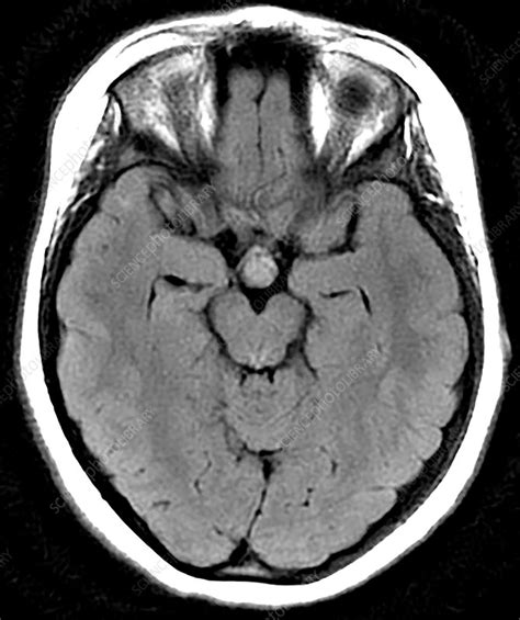 Hypothalamic Hamartoma, MRI   Stock Image   C030/6377   Science Photo ...