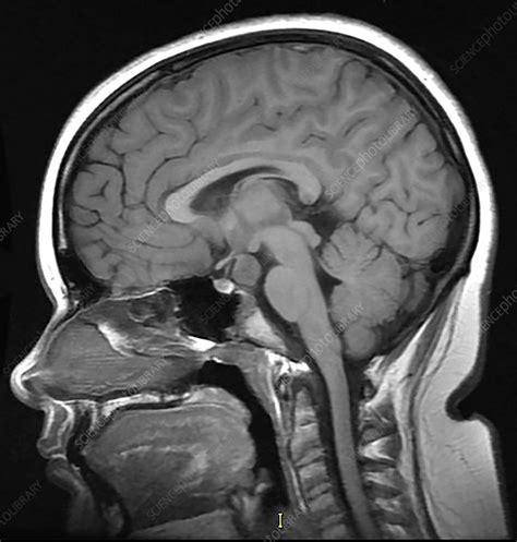 Hypothalamic Hamartoma, MRI   Stock Image   C030/6379   Science Photo ...