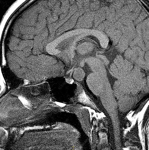 Hypothalamic Hamartoma, MRI   Stock Image   C030/6380   Science Photo ...