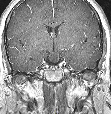 Hypothalamic Hamartoma, MRI   Stock Image   C030/6383   Science Photo ...