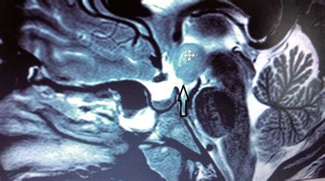 Hypothalamic Hamartoma MRI   Sumer s Radiology Blog