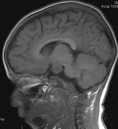 Hypothalamic hamartoma | Radiology Case | Radiopaedia.org