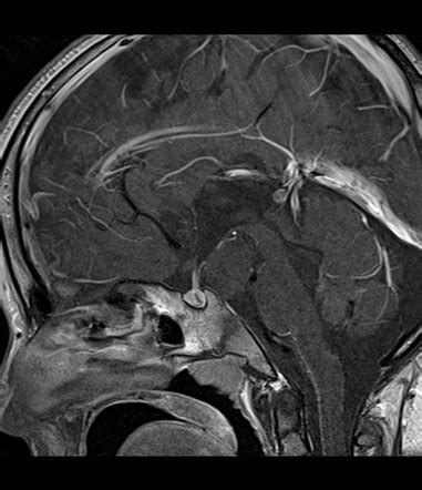 Hypothalamic hamartoma | Radiology Reference Article | Radiopaedia.org