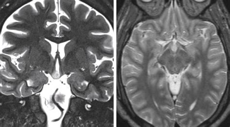Hypothalamic Hamartoma | The Neurosurgical Atlas, by Aaron Cohen Gadol ...