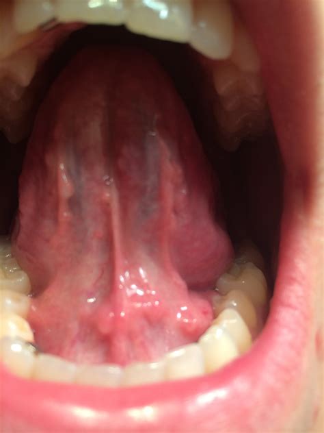 I have had swelling under my tongue as well as many pimple like bumps ...
