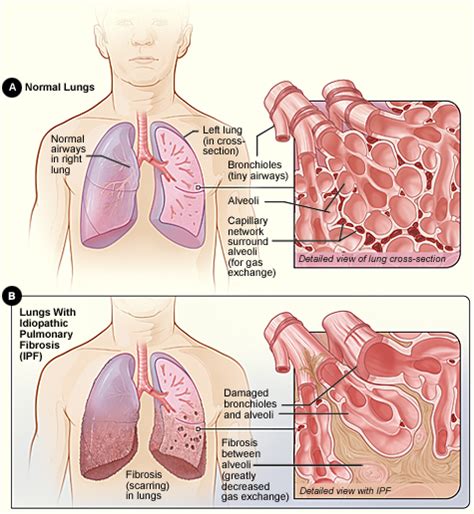 Idiopathic pulmonary fibrosis   Wikipedia