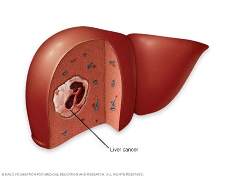Illustration of liver cancer