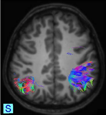 Image in a child with focal cortical dysplasia within the ...