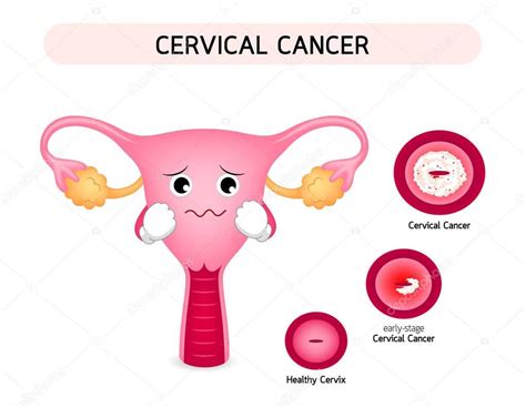 Imágenes: animadas de cancer de cuello uterino | Diagrama ...