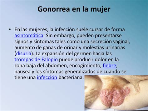 Imagenes De Geninales Con Gonorrea