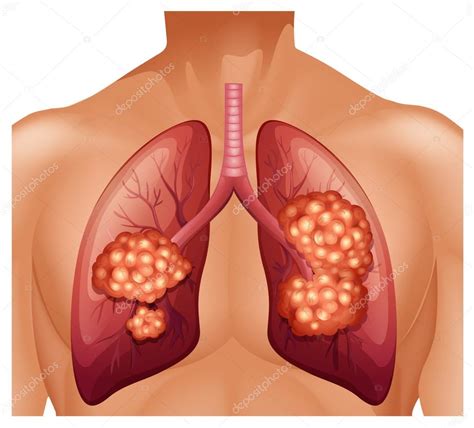 Imágenes: un pulmon con cancer | Cáncer de pulmón en ...