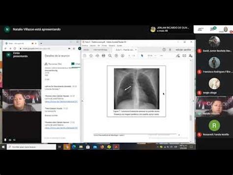 Imagenología | Patrón Acinar, Patrón Intersticial, Nódulo y Masas ...