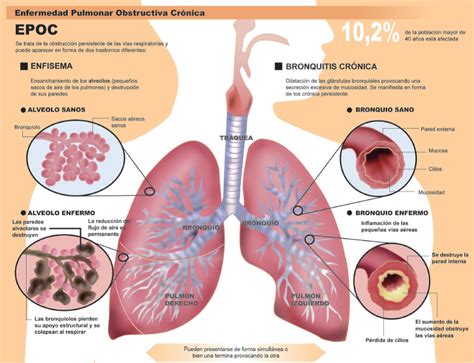 Immunotec Yucatan: Enfisema Pulmonar, EPOC, Bronquitis