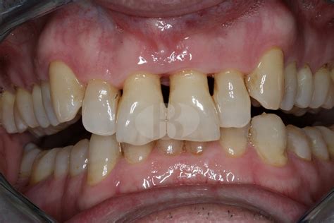 Implante en posición de un incisivo central superior » Clínica Dental ...