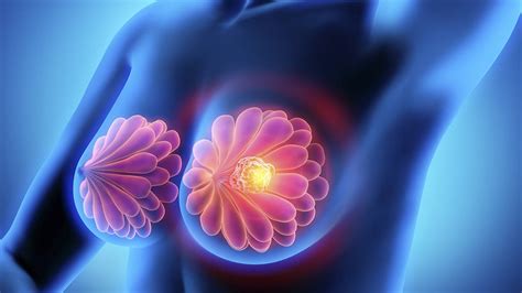 IMSS: Detección oportuna de cáncer de mama es ...
