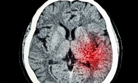 In Intracerebral Hemorrhage, Intensive BP Lowering Has ...