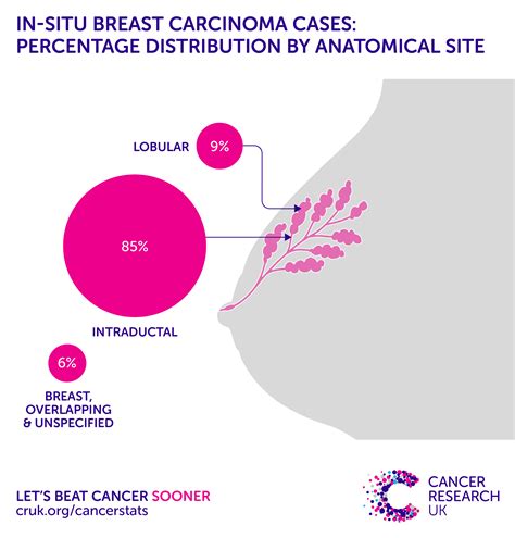 In situ breast carcinoma incidence statistics | Cancer ...