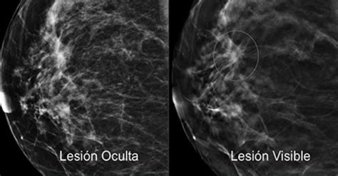 Incidencia, detección y estadios del cáncer de mama