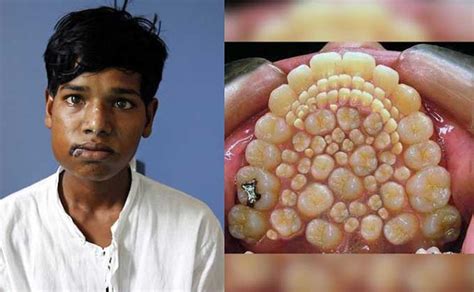 Increíble: le extrajeron 232 dientes a un joven indio   LA GACETA Salta