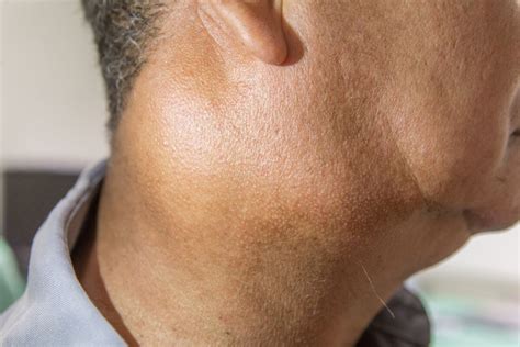 Infección de las glándulas salivales: causas y tratamientos   Mejor con ...