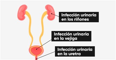 Infección de orina: Síntomas según el tipo de infección ...