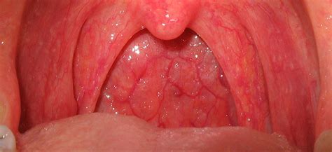 Infección En La Garganta: Causas, Síntomas Y Tratamiento ...