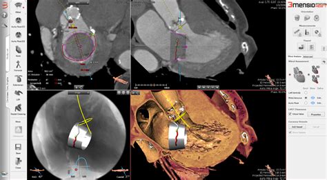 Infinix i | Angiography | Technology | Canon Medical Systems