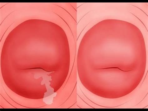 Inflamación del cuello uterino con sangrado anormal   YouTube