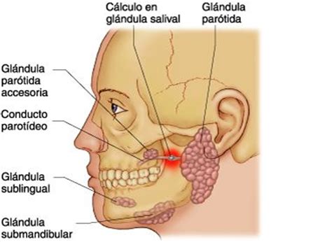 Inflamación glándula salival, sialolitiasis   Glándula Parótida