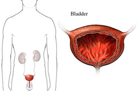 Inflammation, bladder. Causes, symptoms, treatment ...