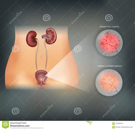 Inflammation Of The Urinary Bladder Stock Vector ...