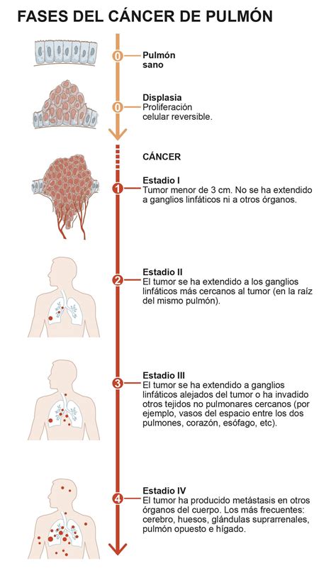 Infográfico. Fases y estadíos del cáncer de pulmón ...