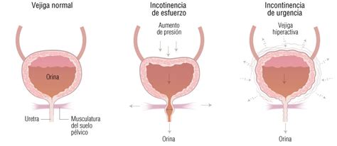 Información de Incontinencia urinaria de la mujer