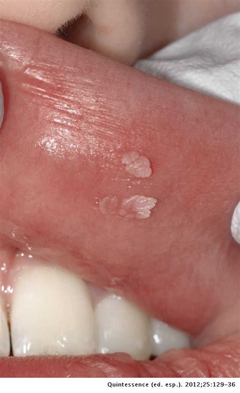 Inmigración compresión inercia tumores benignos de cavidad oral ...