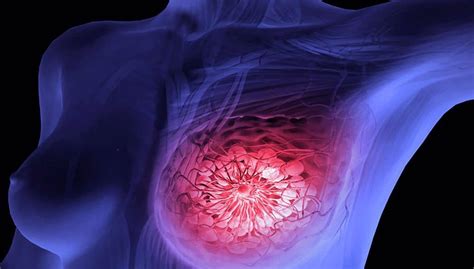 Inteligencia artificial puede detectar cáncer de mama 5 ...