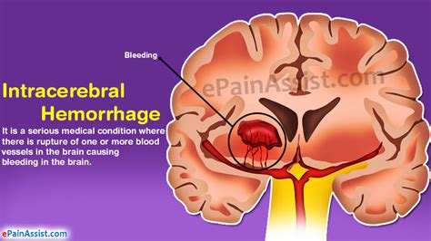 Intracerebral Hemorrhage|Causes|Symptoms|Investigations ...